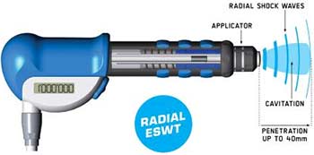 onde-urto-ems-radial-shock-waves